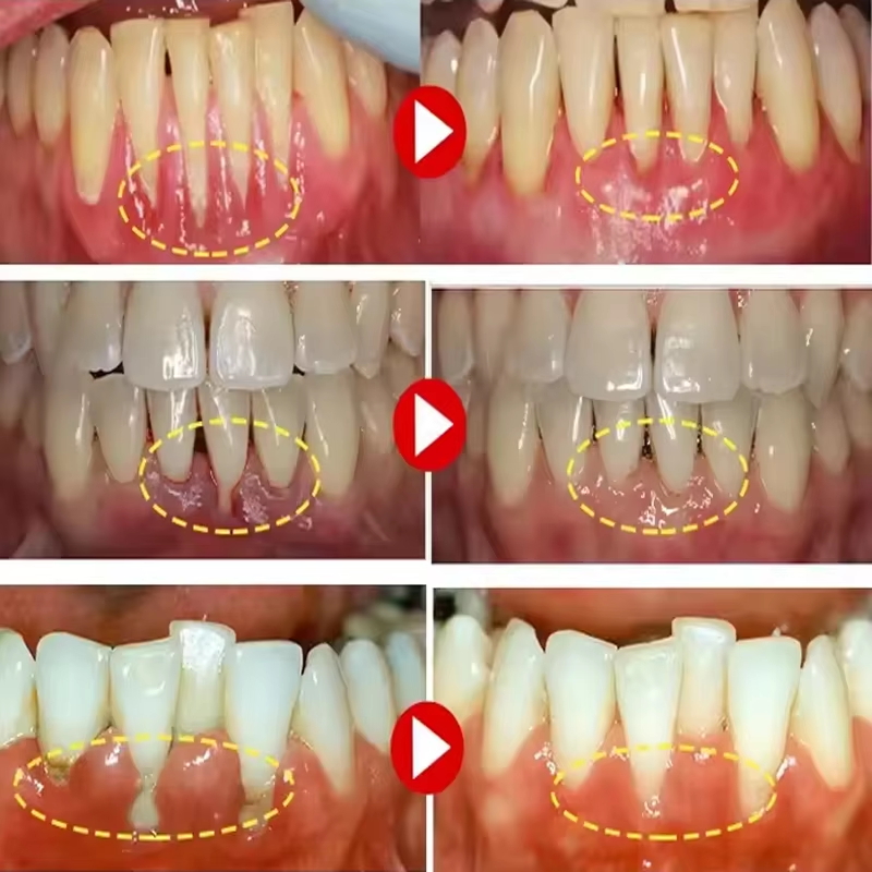 Gel Pemutih Gigi Perawatan Per - Teeth Whitening Gel ulasan dan harga